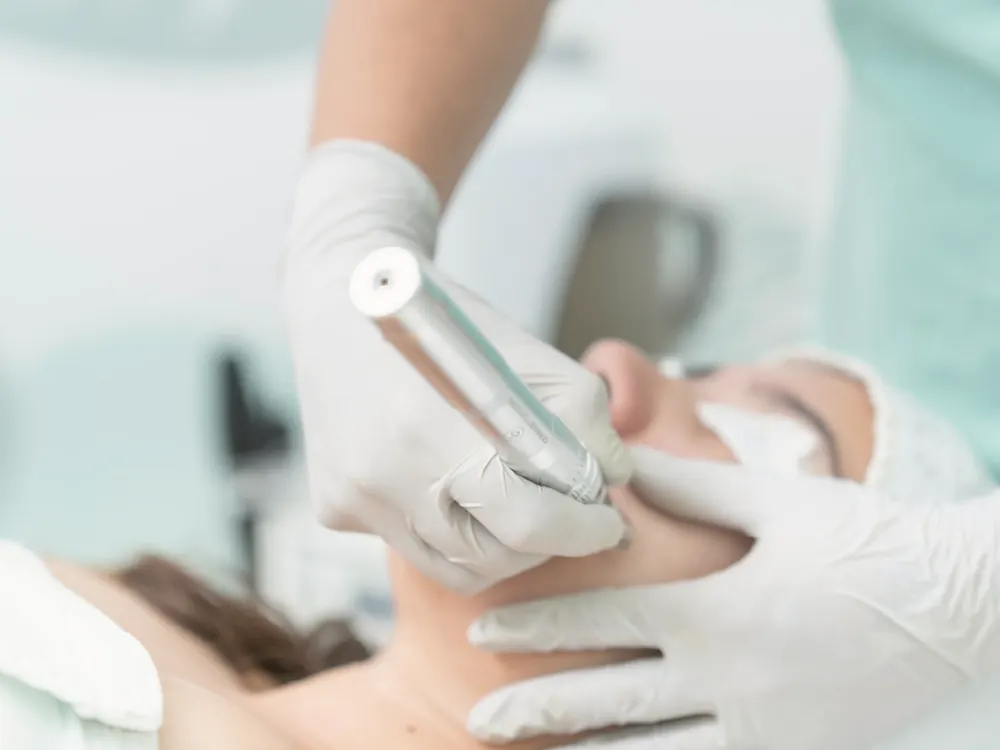 Specialist performing a microneedling treatment